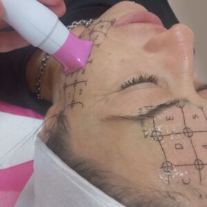 Thermage® – Златният стандарт в неинвазивното стягане на кожата