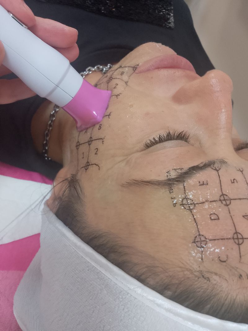 Thermage® – Златният стандарт в неинвазивното стягане на кожата